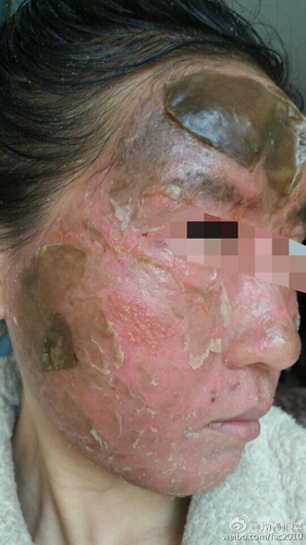 皮炎反复发作怎么办 皮炎反复发作怎么办