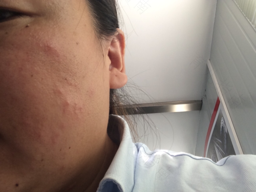 吃了河虾过敏怎么办