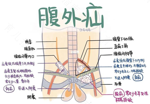 腹股沟疝气如何治疗