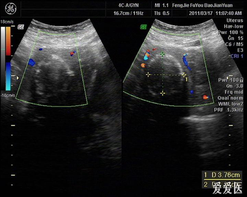 子宫内膜多发钙化斑 子宫内膜多发钙化斑