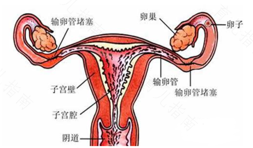输卵管积水有炎症怎么治疗最快最好 输卵管积水有炎症怎么治疗最快最好