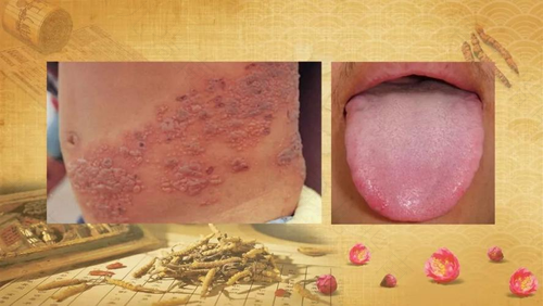 孕妇出水痘外阴也长怎么办 孕妇出水痘外阴也长怎么办