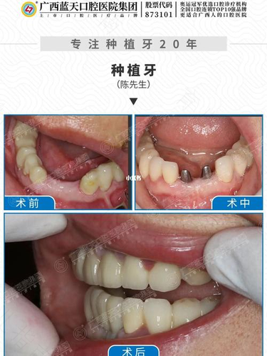 拔牙后多长时间种牙最好 拔牙后多长时间种牙最好