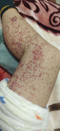 过敏性紫癜引起的腹痛怎么办