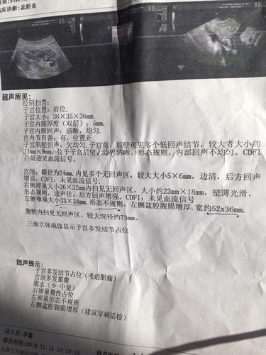 宫颈多发囊性结节严重吗