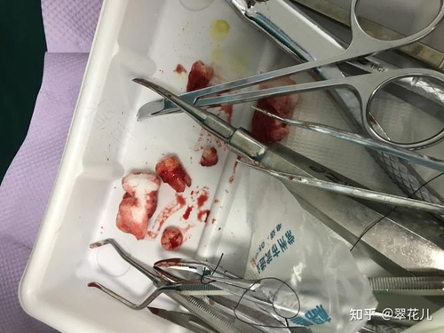 拔牙后需要打几天消炎针 拔牙后需要打几天消炎针