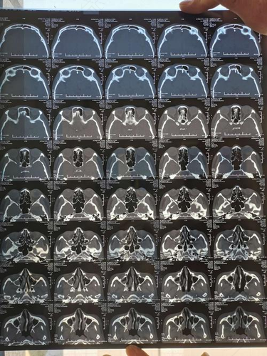 眼眶下壁骨折是什么伤 眼眶下壁骨折是什么伤