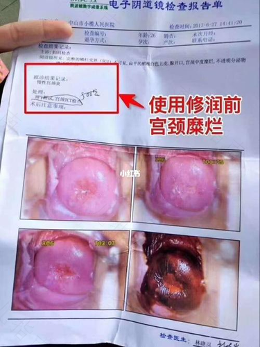 轻度宫颈炎是怎么引起的 轻度宫颈炎是怎么引起的