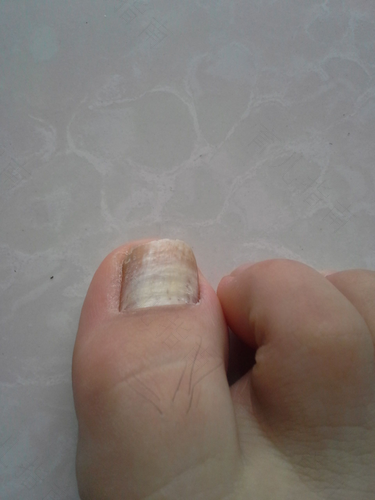 大脚趾指甲空了怎么回事 大脚趾指甲空了怎么回事