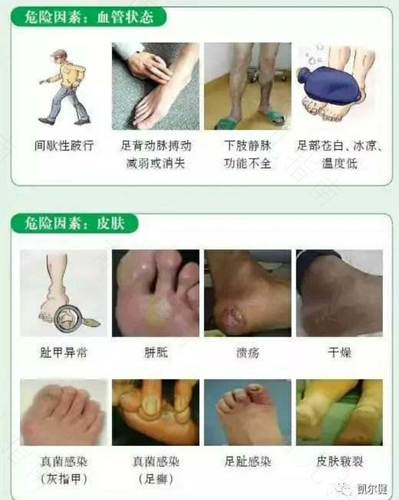 2型糖尿病症状的早期表现