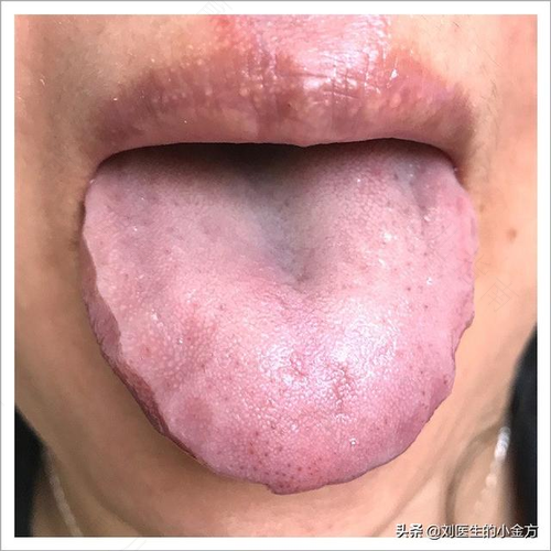 舌边红是什么原因及治疗 舌边红是什么原因及治疗