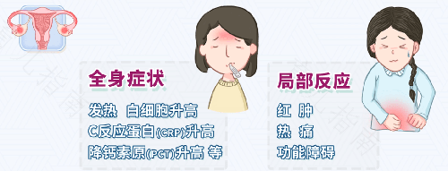 盆腔炎症状如何治疗 盆腔炎症状如何治疗