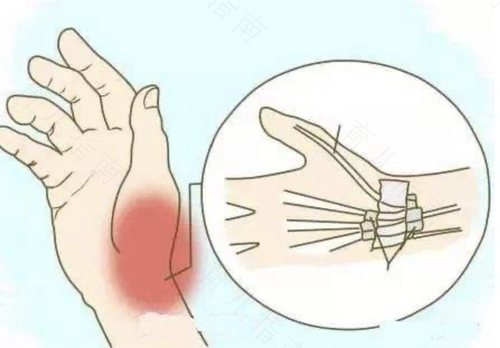 狭窄性的腱鞘炎怎么治愈 狭窄性的腱鞘炎怎么治愈