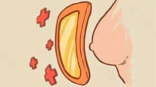 乳腺脓肿做微创能治好吗 乳腺脓肿做微创能治好吗