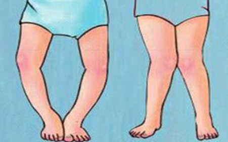 轻微佝偻病怎么治疗 轻微佝偻病怎么治疗