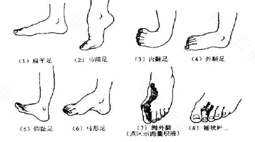 扁平足足外翻能治好吗