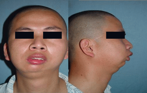 小下颌畸形是什么原因引起的 小下颌畸形是什么原因引起的