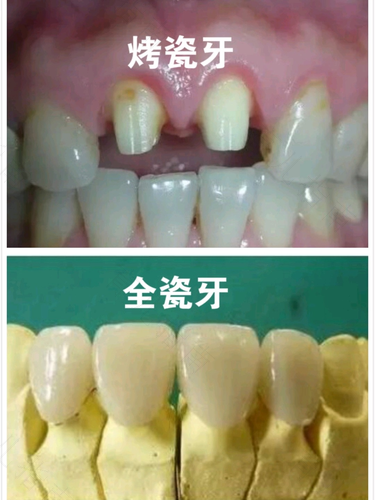 拔完牙多久可以镶牙? 拔完牙多久可以镶牙?