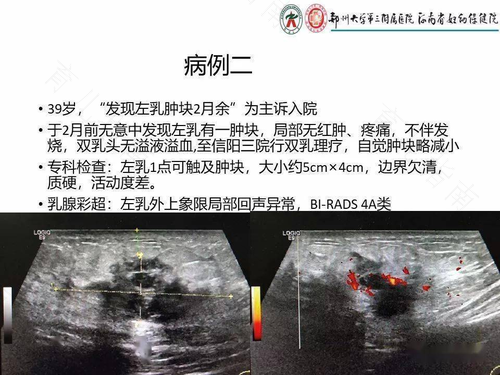 乳腺炎硬块一直不消怎么办 乳腺炎硬块一直不消怎么办