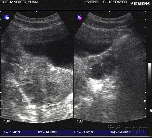 巧囊术后复发率多高 巧囊术后复发率多高