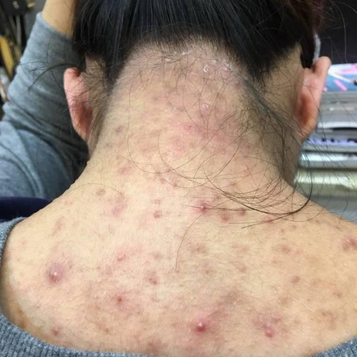 男孩外阴长了个大痘怎么办