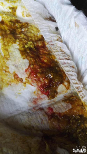 拉肚子还有血怎么回事 拉肚子还有血怎么回事