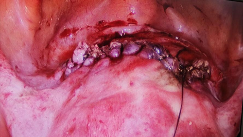 子宫瘢痕愈合不良的症状 子宫瘢痕愈合不良的症状