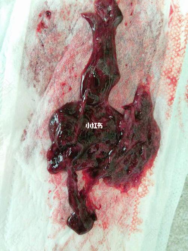 子宫内有血块是什么原因引起的 子宫内有血块是什么原因引起的