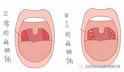 扁桃体发炎的治疗方法