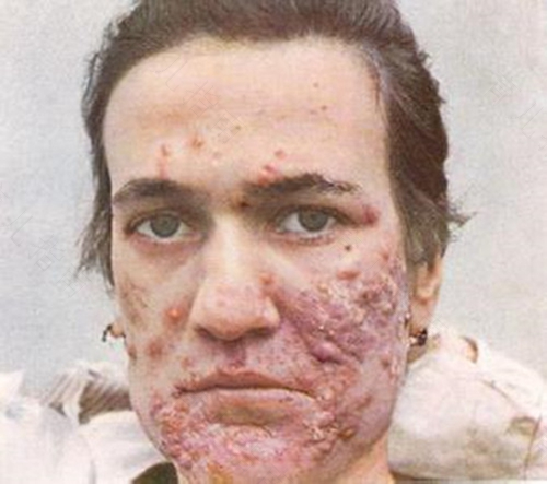 疤痕体质有遗传性吗 疤痕体质有遗传性吗