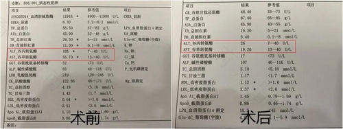 谷草转氨酶高68怎么办 谷草转氨酶高68怎么办