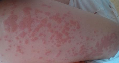 得了风疹不能吃什么 得了风疹不能吃什么