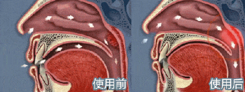 喉咙痛后喉咙痒鼻塞是什么感冒 喉咙痛后喉咙痒鼻塞是什么感冒