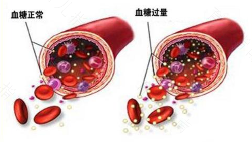 激素导致血糖高怎么办打 激素导致血糖高怎么办打