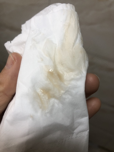 有血褐色分泌物怎么回事