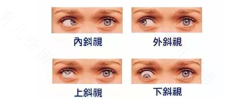 先天性眼球震颤怎么办 先天性眼球震颤怎么办