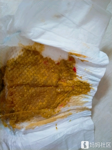 大便有血块儿是咋回事儿? 大便有血块儿是咋回事儿?