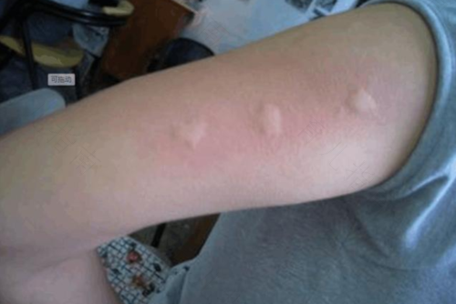 身上长风坨怎么办