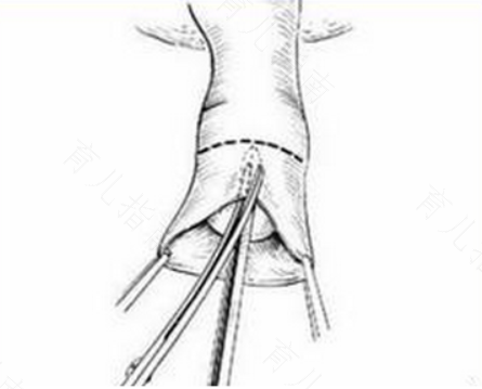 割完包茎多久能好