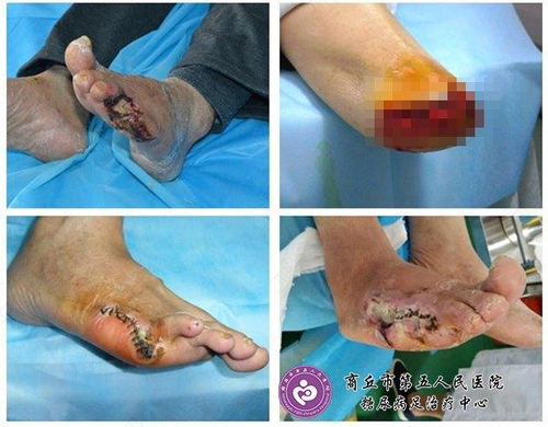 腰部肌肉摔伤怎么办恢复快 腰部肌肉摔伤怎么办恢复快