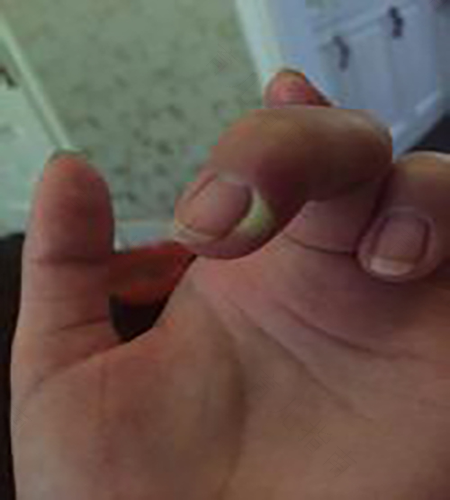 甲沟炎一直有脓怎么办 甲沟炎一直有脓怎么办