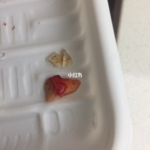 一颗牙齿拔了要痛几天 一颗牙齿拔了要痛几天