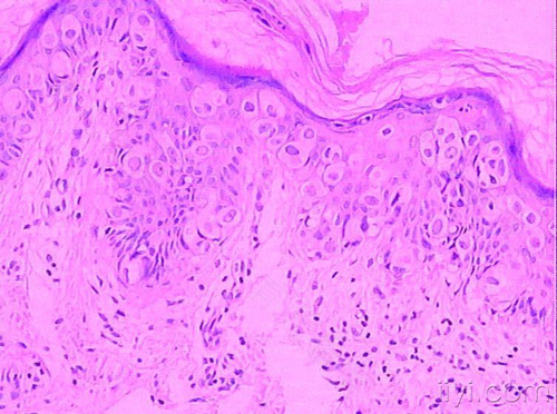 皮下囊肿什么原因引起的 皮下囊肿什么原因引起的