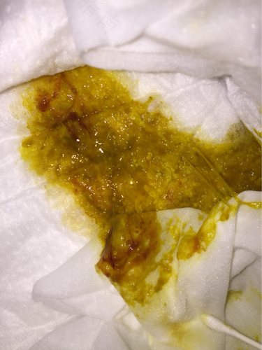 拉屎太用力出血了怎么办