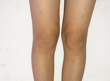 肾炎会导致膝盖疼吗