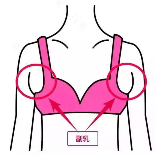 乳房有副乳是怎么回事