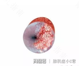 息肉有良性恶性之分吗 息肉有良性恶性之分吗