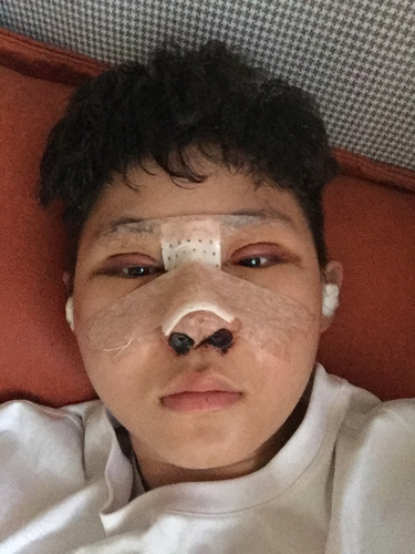 两边鼻子都塞住了怎么办 两边鼻子都塞住了怎么办