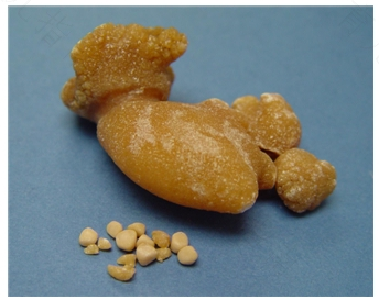 肾结石能不能吃碱面 肾结石能不能吃碱面