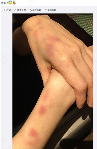 胳膊拉伤怎么办恢复快发烫 胳膊拉伤怎么办恢复快发烫